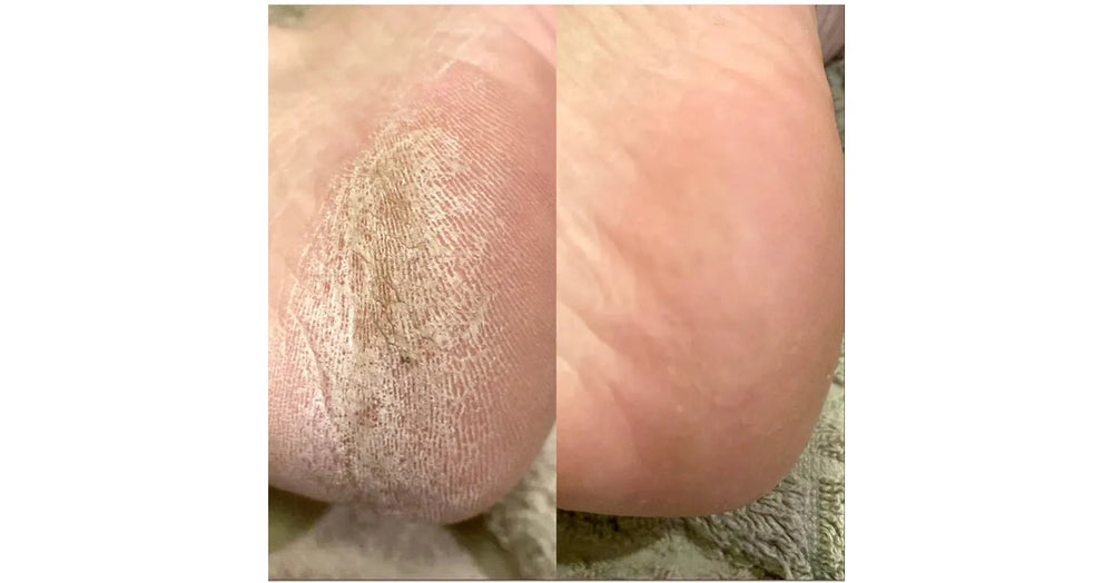 LovaSkin Instant Foot Peel (75ml)