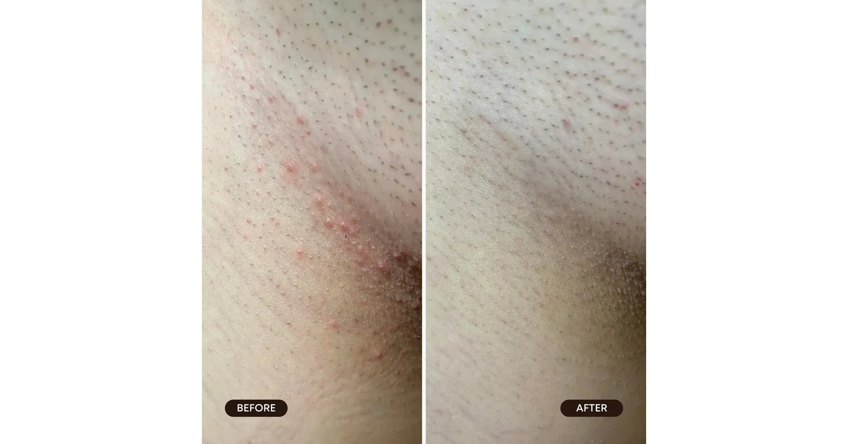 Bushbalm Berry Crush Exfoliating Scrub Ingrown Hair (8oz/236ml)